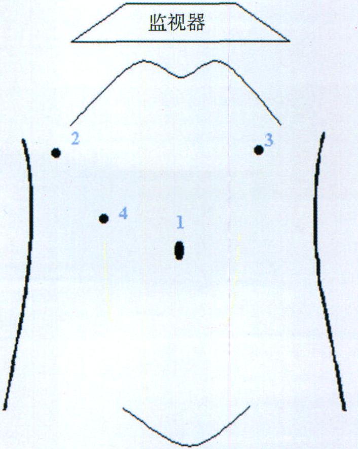 42.膽總管囊腫根治術(shù)